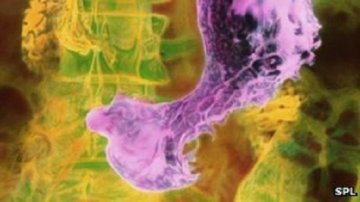 科学家找到快速诊断胃癌的呼吸测试方法