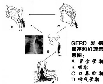 胃食管喉气管综合征：一个未被认知的症候群