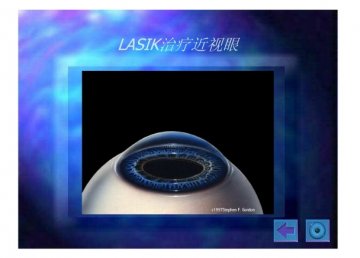 lasik9