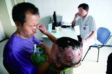 男童被烧伤戴面具生活续：喉镜检查后定手术方案